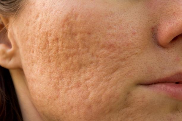 traitement acné visage